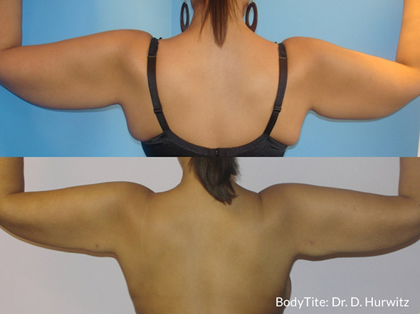 BodyTite Before and After Photos