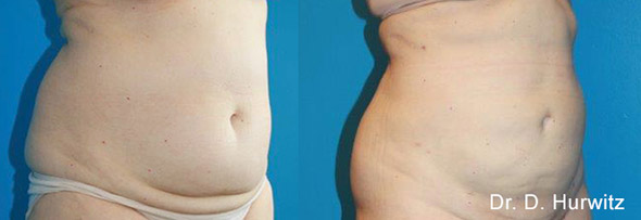 BodyTite Before and After Photos