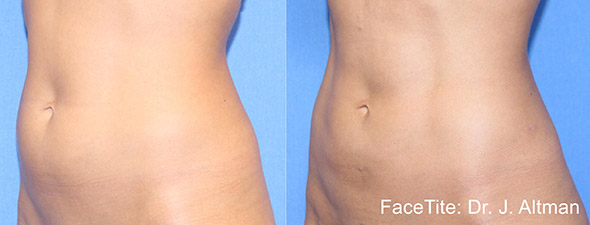 BodyTite Before and After Photos